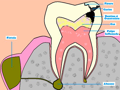 Absceso Dental o Flemón