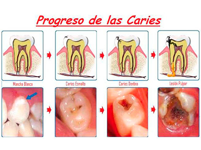 Caries