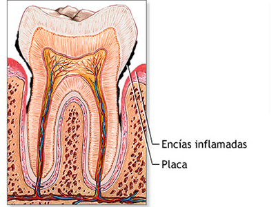 Gingivitis
