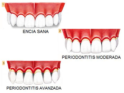 Periodontitis